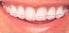 Clear or ceramic braces Clear or ceramic braces