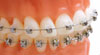 Damon braces Damon braces