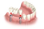 Multiple Dental Implants Multiple Dental Implants