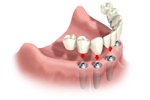 Full Jaw - Implant Bridge Full Jaw - Implant Bridge