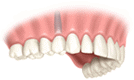 Single Dental Implant Single Dental Implant