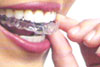 Invisalign Invisalign