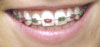 Metal braces Metal braces