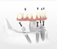 Dental Implants Dental Implants