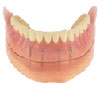 Overdentures Overdentures