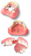 Removable Partial Dentures Removable Partial Dentures