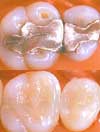 Teeth Fillings Teeth Fillings